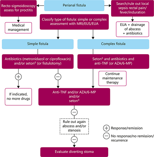 Sulz et al - Management of fistulizing perianal disease. Simple fistulae: Low fistulae that involve superficial tissue and include subcutaneous and intersphincteric and intrasphincteric fistulae that remain below the dentate line, have a single opening and are not associated with perianal complications. Complex fistulae: are high (high means involving >2/3 of the external sphincter) intersphincteric, high transsphincteric, suprasphincteric, and extrasphincteric, may have multiple openings, and may be associated with an abscess, proctitis, rectal stricture or may be connected with the bladder or vagina. ◊ Seton: Seton, not cutting. AZA, azathioprine; EUA, examination under anesthesia; EUS, endoscopic ultrasonography; 6-MP, 6-mercaptopurine; MRI, magnetic resonance imaging; TNF, tumor